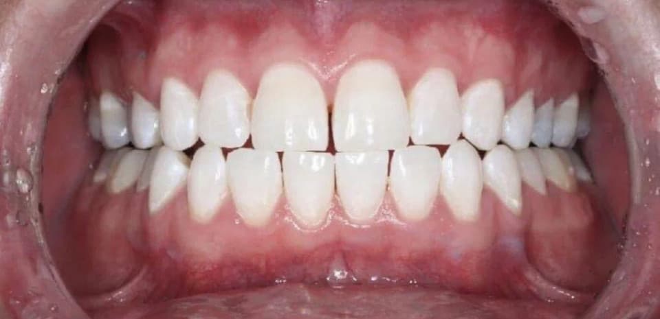 Teeth after WhitenPro Clinic treatment