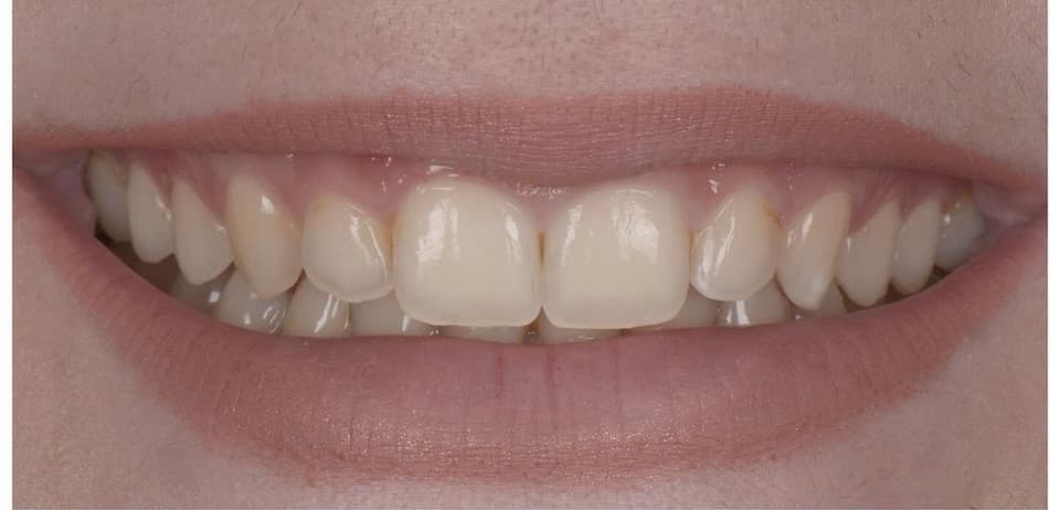 Teeth before WhitenPro Home treatment