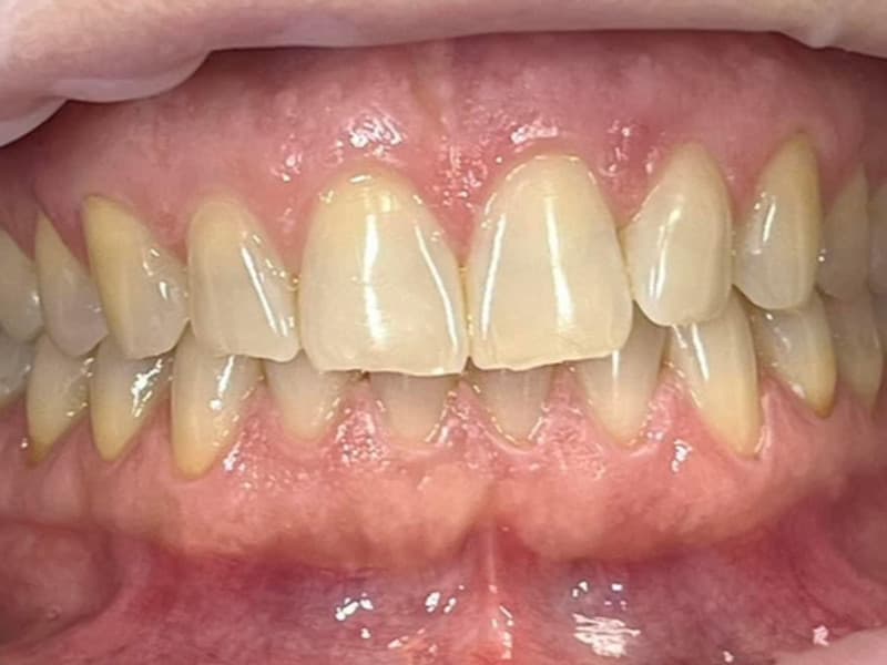 Teeth before WhitenPro Home Sensitive treatment
